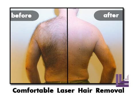 laser hair removal st ives|Using Laser Hair Removal St Ives: What You Should Know